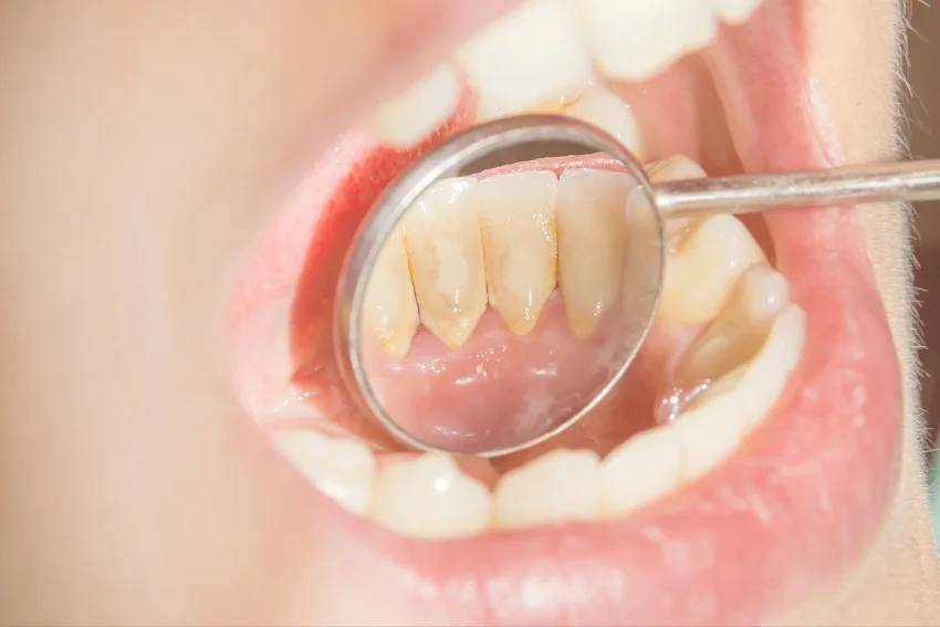 10 Langkah Preventif Agar Terhindar dari Penyakit Gusi Kronis